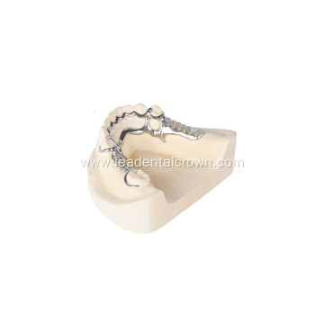 Metal Cast Partial Framework in Prosthodontics